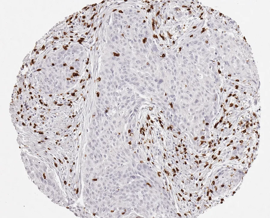 Immunohistochemistry of human CD8 with anti-CD8 clone TC8 (DIA-TC8) in FFPE tissue – CD8-positive lymphocytes, in this case predominantly located in the cancer stroma in squamous cell carcinoma of the cervix uteri; figure 14 of the ONCOdianova CD8 gallery.