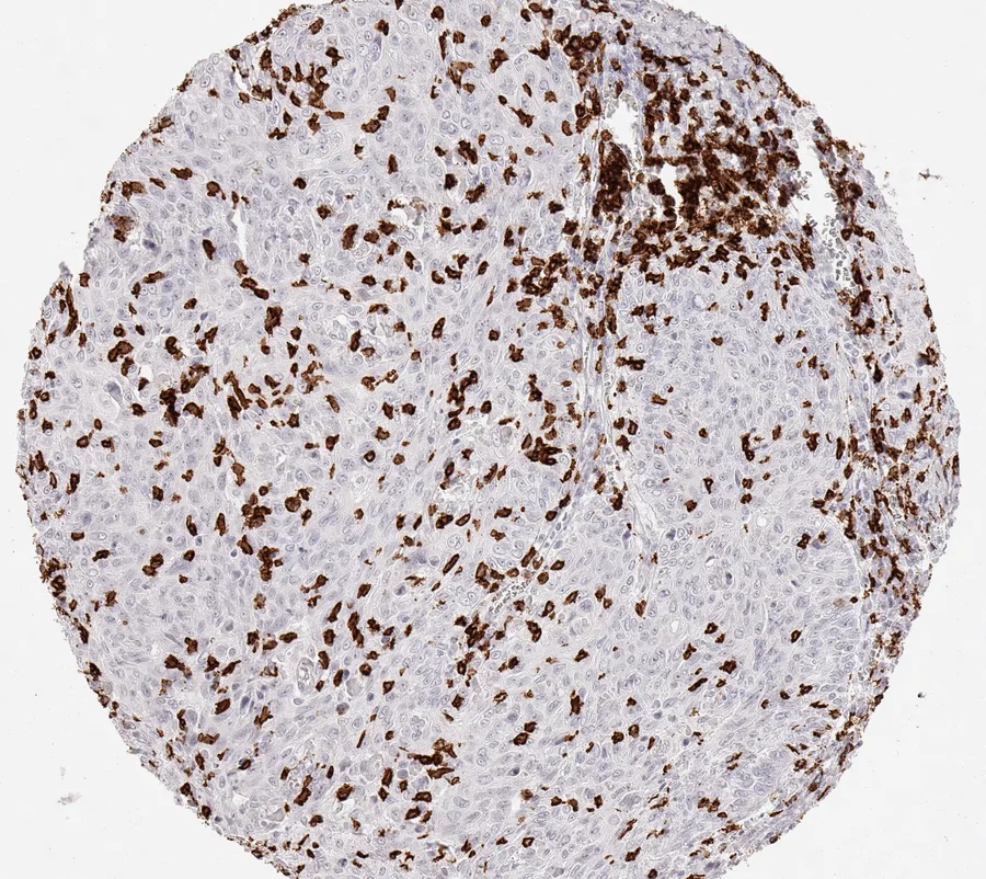 Immunohistochemistry of human CD8 with anti-CD8 clone TC8 (DIA-TC8) in FFPE tissue – CD8-positive lymphocytes, in this case located both in the cancer stroma and within cancer cell nests in squamous cell carcinoma of the cervix uteri; figure 15 of the ONCOdianova CD8 gallery.