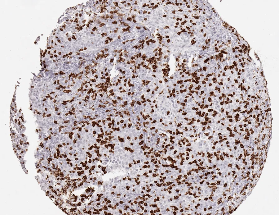 Immunohistochemistry of human CD8 with anti-CD8 clone TC8 (DIA-TC8) in FFPE tissue – very dense lymphocytic infiltration in squamous cell carcinoma of the cervix uteri; figure 16 of the ONCOdianova CD8 gallery.