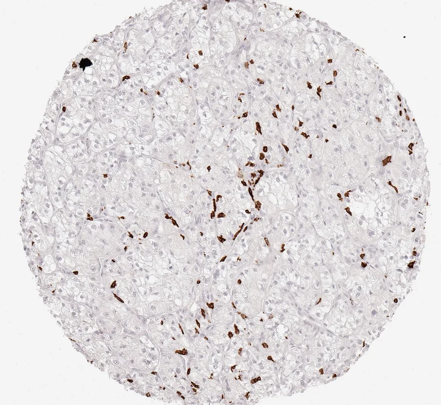 Immunohistochemistry of human CD8 with anti-CD8 clone TC8 (DIA-TC8) in FFPE tissue – moderately dense infiltration by CD8-positive lymphocytes in clear cell kidney cancer; figure 20 of the ONCOdianova CD8 gallery.