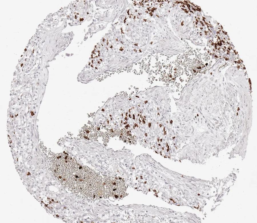 Immunohistochemistry of human CD8 with anti-CD8 clone TC8 (DIA-TC8) in FFPE tissue – only few scattered CD8-positive lymphocytes in clear cell kidney cancer; figure 22 of the ONCOdianova CD8 gallery.