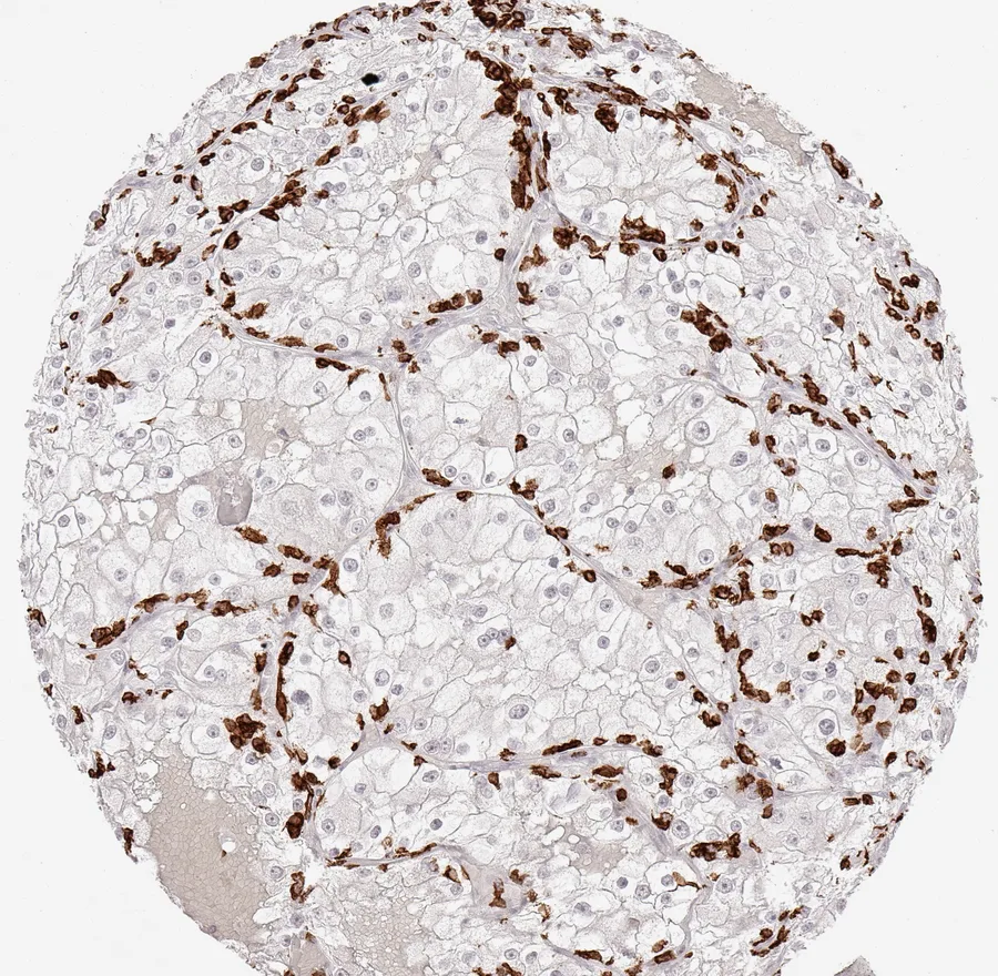 Immunohistochemistry of human CD8 with anti-CD8 clone TC8 (DIA-TC8) in FFPE tissue – high number of CD8-positive lymphocytes, regularly arranged at the periphery of tumour cell sheets in clear cell kidney cancer; figure 23 of the ONCOdianova CD8 gallery.