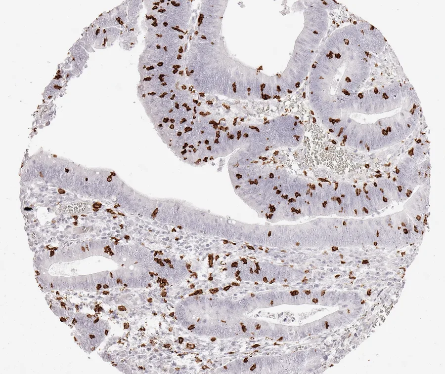 Immunohistochemistry of human CD8 with anti-CD8 clone TC8 (DIA-TC8) in FFPE tissue – CD8-positive lymphocytes in colon adenoma; figure 28 of the ONCOdianova CD8 gallery.