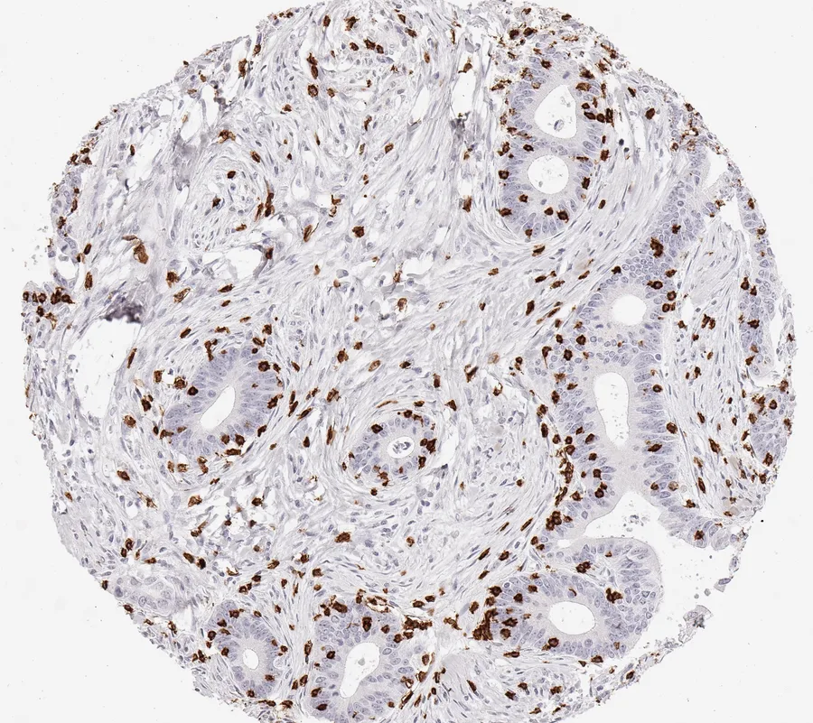 Immunohistochemistry of human CD8 with anti-CD8 clone TC8 (DIA-TC8) in FFPE tissue – CD8-positive lymphocytes in endometrioid ovarian cancer; figure 11 of the ONCOdianova CD8 gallery.