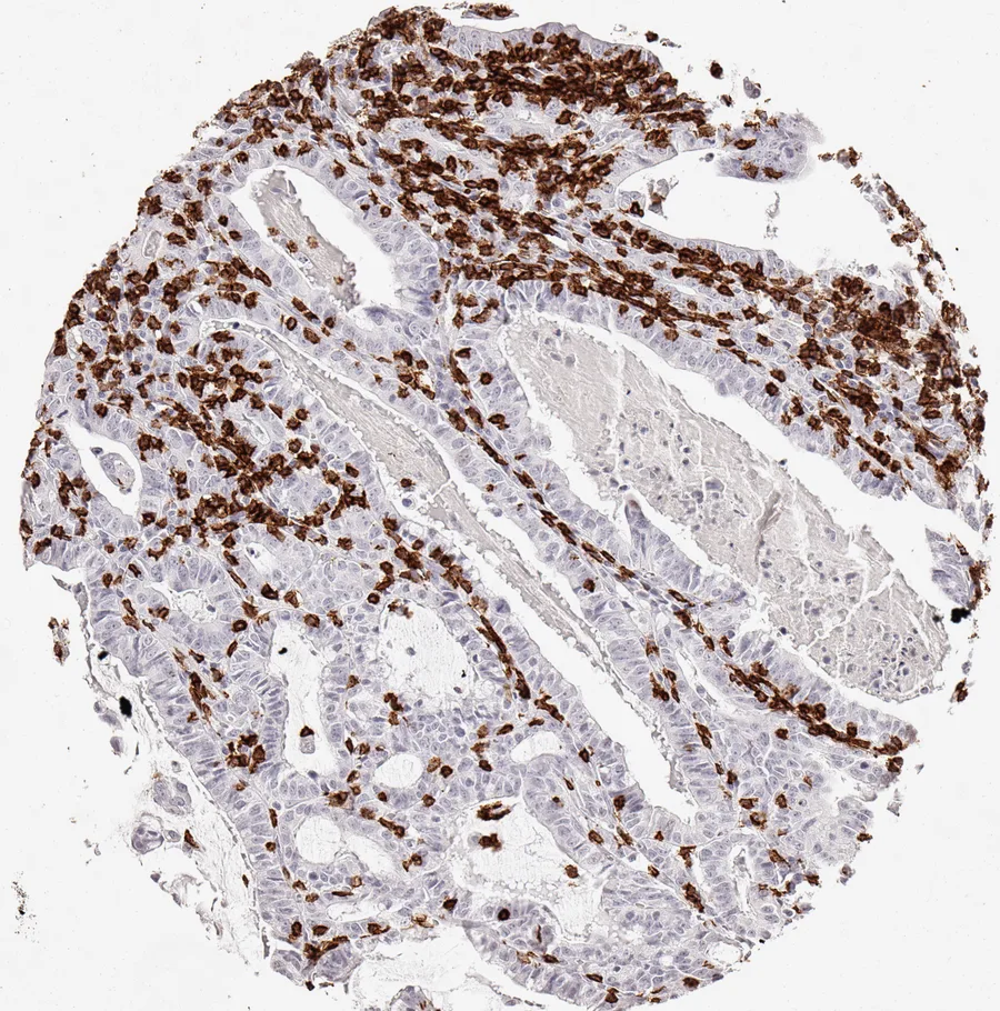 Immunohistochemistry of human CD8 with anti-CD8 clone TC8 (DIA-TC8) in FFPE tissue – dense infiltrate of CD8-positive lymphocytes in adenocarcinoma of the oesophagus; figure 05 of the ONCOdianova CD8 gallery.