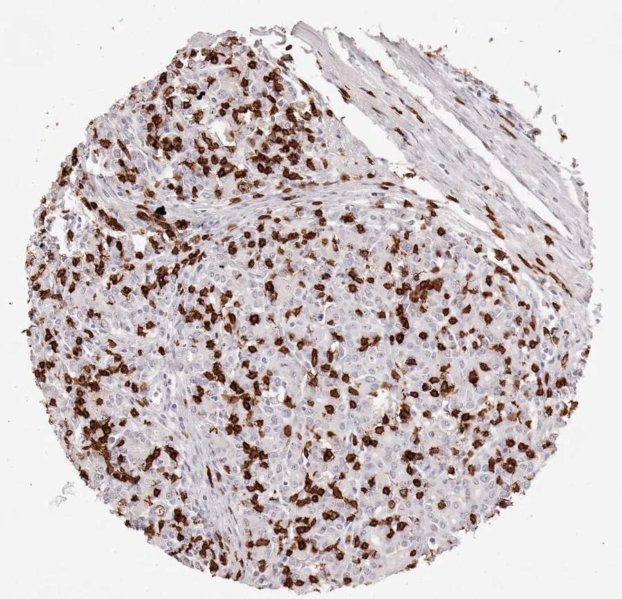 Immunohistochemistry of human CD8 with anti-CD8 clone TC8 (DIA-TC8) in FFPE tissue – very high density of CD8-positive lymphocytes in adenocarcinoma of the oesophagus; figure 06 of the ONCOdianova CD8 gallery.