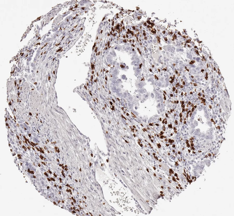 Immunohistochemistry of human CD8 with anti-CD8 clone TC8 (DIA-TC8) in FFPE tissue – CD8-positive lymphocytes predominantly located in the tumour stroma in adenocarcinoma of the oesophagus; figure 07 of the ONCOdianova CD8 gallery.
