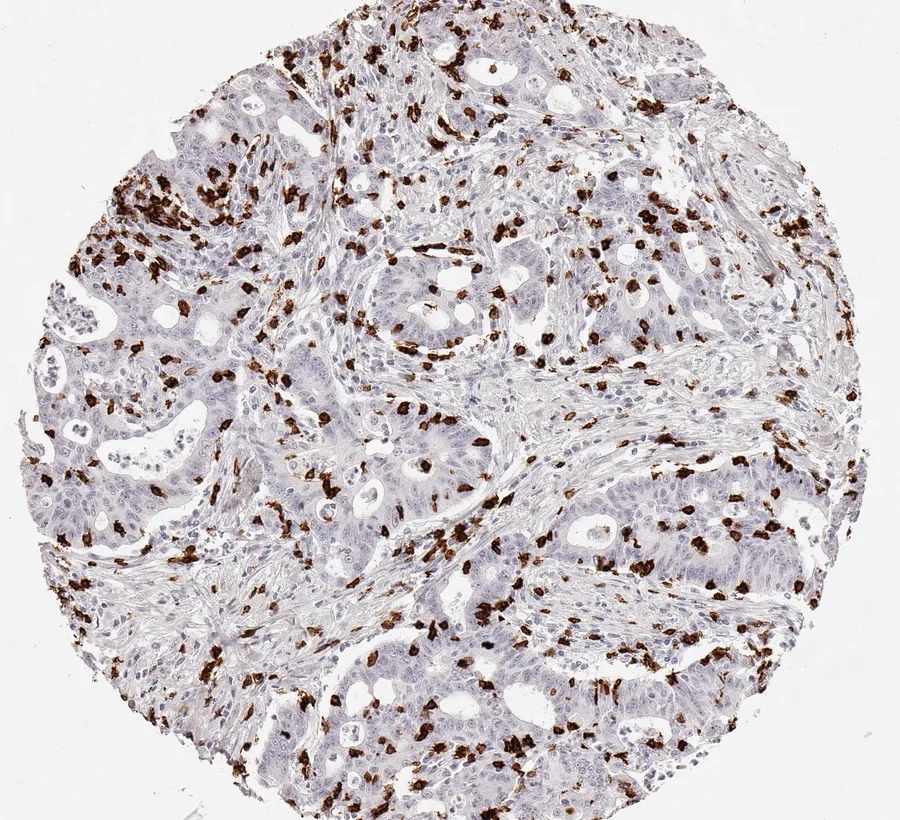 Immunohistochemistry of human CD8 with anti-CD8 clone TC8 (DIA-TC8) in FFPE tissue – moderately dense infiltration by CD8-positive cells in intestinal-type gastric cancer; figure 08 of the ONCOdianova CD8 gallery.