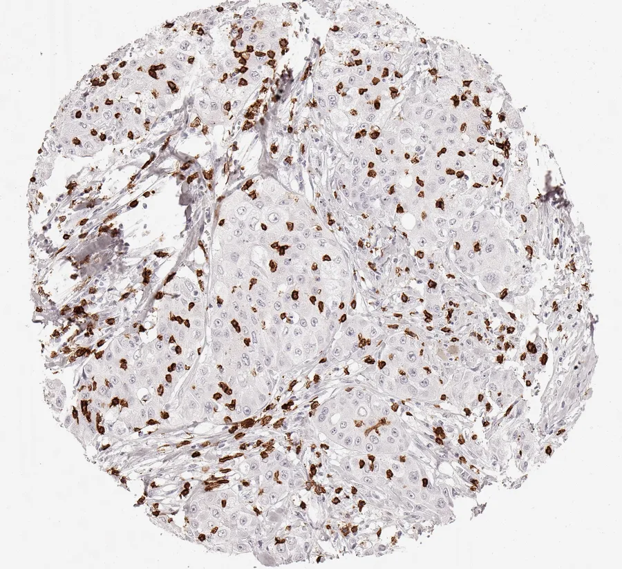 Immunohistochemistry of human CD8 with anti-CD8 clone TC8 (DIA-TC8) in FFPE tissue – marked infiltration by CD8-positive lymphocytes, predominantly located between cancer cells with immediate contact to neoplastic cells in adenocarcinoma of the lung; figure 03 of the ONCOdianova CD8 gallery.