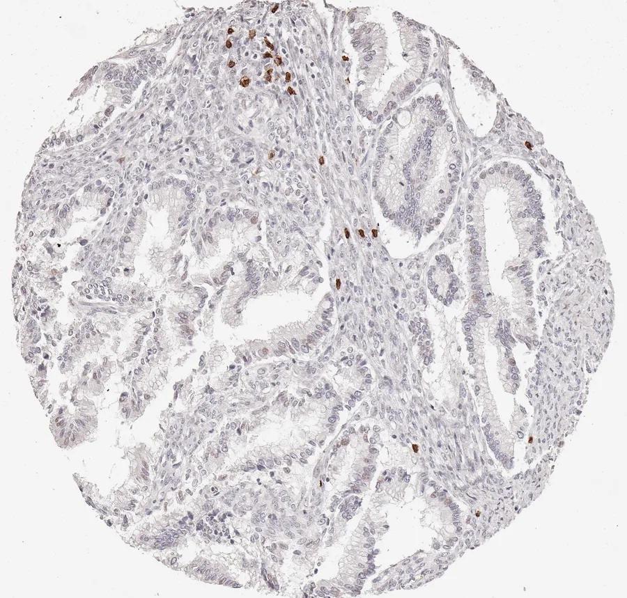 Immunohistochemistry of human CD8 with anti-CD8 clone TC8 (DIA-TC8) in FFPE tissue – only few CD8-positive lymphocytes in mucinous ovarian tumour; figure 10 of the ONCOdianova CD8 gallery.