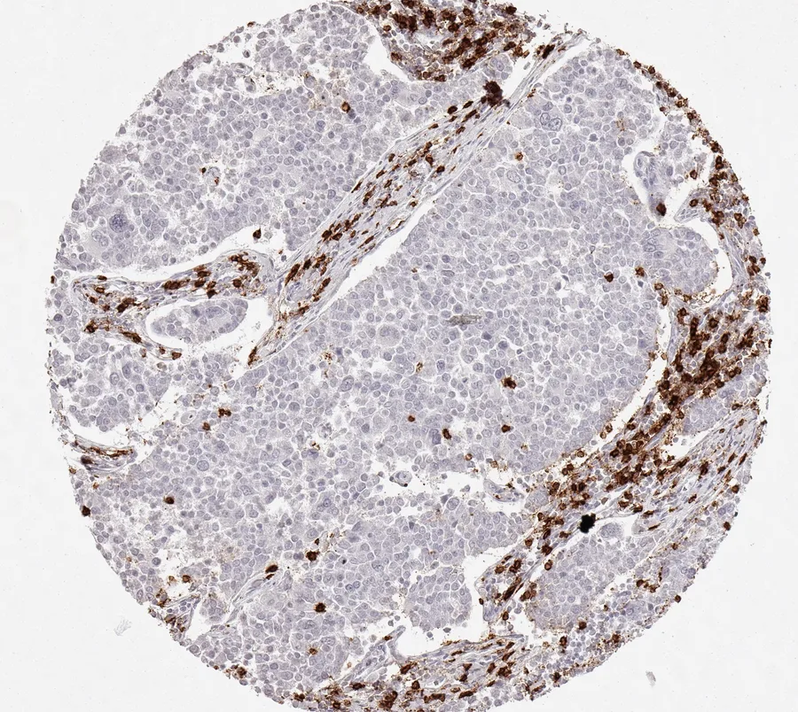 Immunohistochemistry of human CD8 with anti-CD8 clone TC8 (DIA-TC8) in FFPE tissue – CD8-positive lymphocytes primarily located in the tumour stroma in neuroendocrine tumour of the pancreas; figure 32 of the ONCOdianova CD8 gallery.