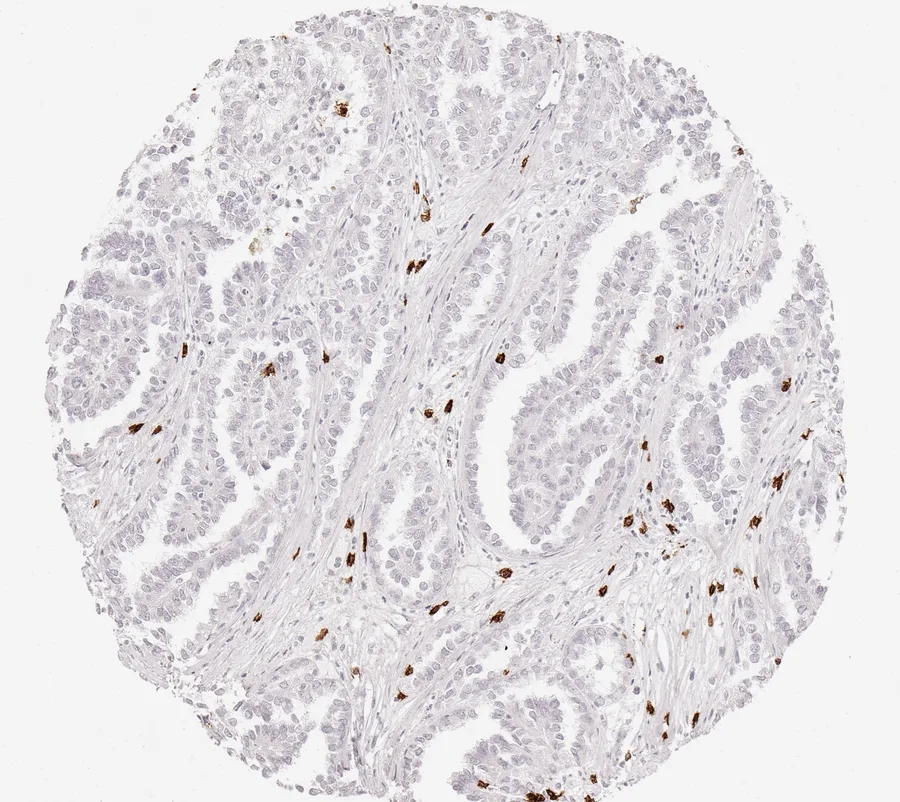 Immunohistochemistry of human CD8 with anti-CD8 clone TC8 (DIA-TC8) in FFPE tissue – few CD8-positive lymphocytes in papillary kidney cancer; figure 19 of the ONCOdianova CD8 gallery.