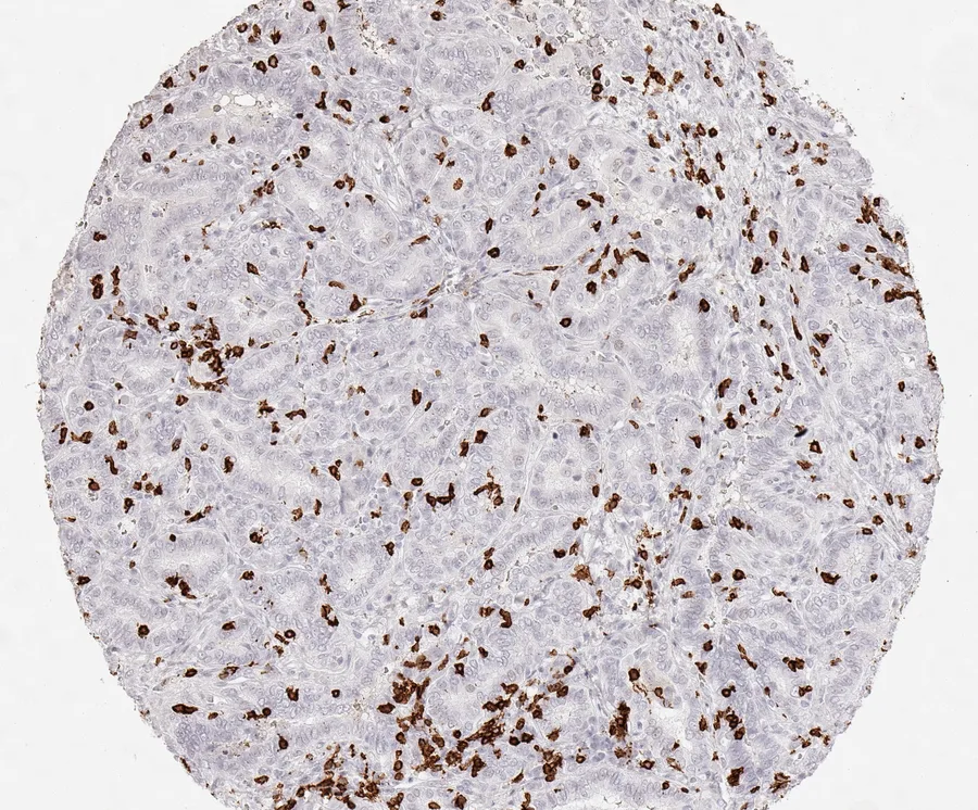 Immunohistochemistry of human CD8 with anti-CD8 clone TC8 (DIA-TC8) in FFPE tissue – dense infiltration by CD8-positive lymphocytes in papillary carcinoma of the thyroid; figure 34 of the ONCOdianova CD8 gallery.
