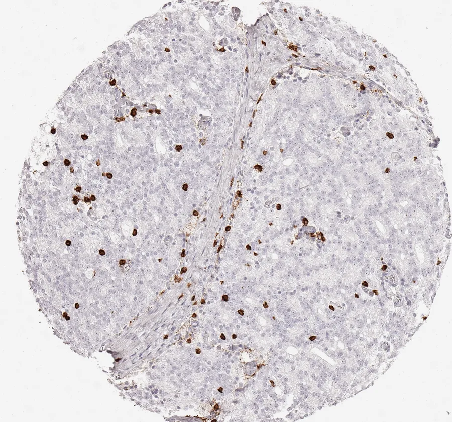 Immunohistochemistry of human CD8 with anti-CD8 clone TC8 (DIA-TC8) in FFPE tissue – infiltrated by CD8-positive lymphocytes in adenocarcinoma of the prostate; figure 02 of the ONCOdianova CD8 gallery.