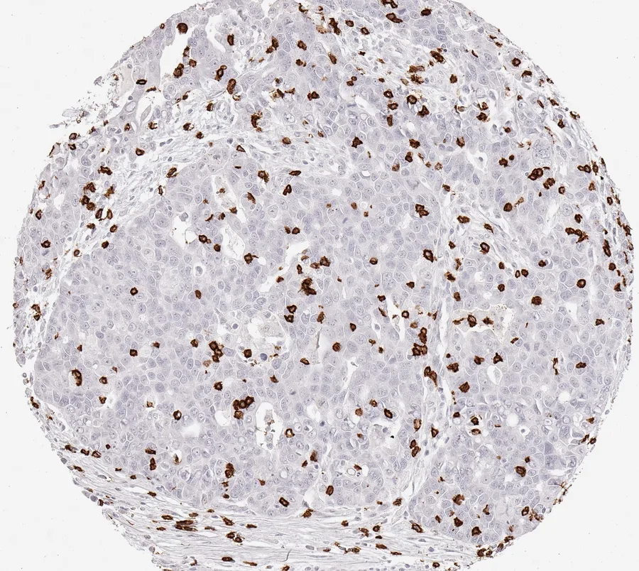 Immunohistochemistry of human CD8 with anti-CD8 clone TC8 (DIA-TC8) in FFPE tissue – dense infiltrate of CD8-positive lymphocytes in serous carcinoma of the ovary; figure 12 of the ONCOdianova CD8 gallery.