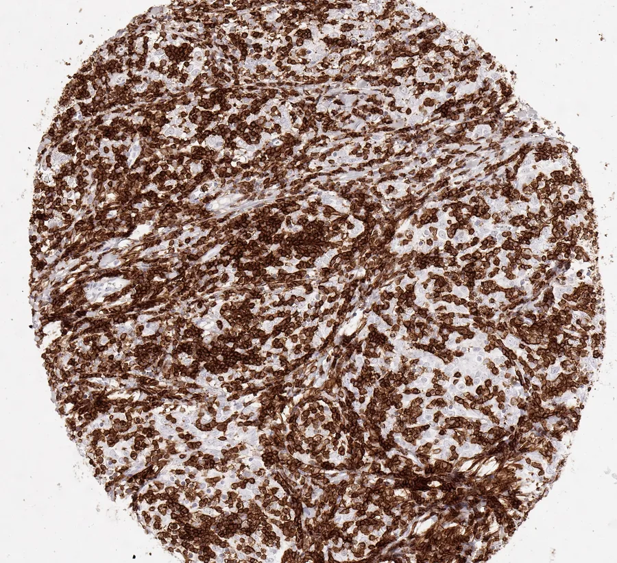 Immunohistochemistry of human CD8 with anti-CD8 clone TC8 (DIA-TC8) in FFPE tissue – CD8-positive lymphocytes in thymoma; figure 35 of the ONCOdianova CD8 gallery.
