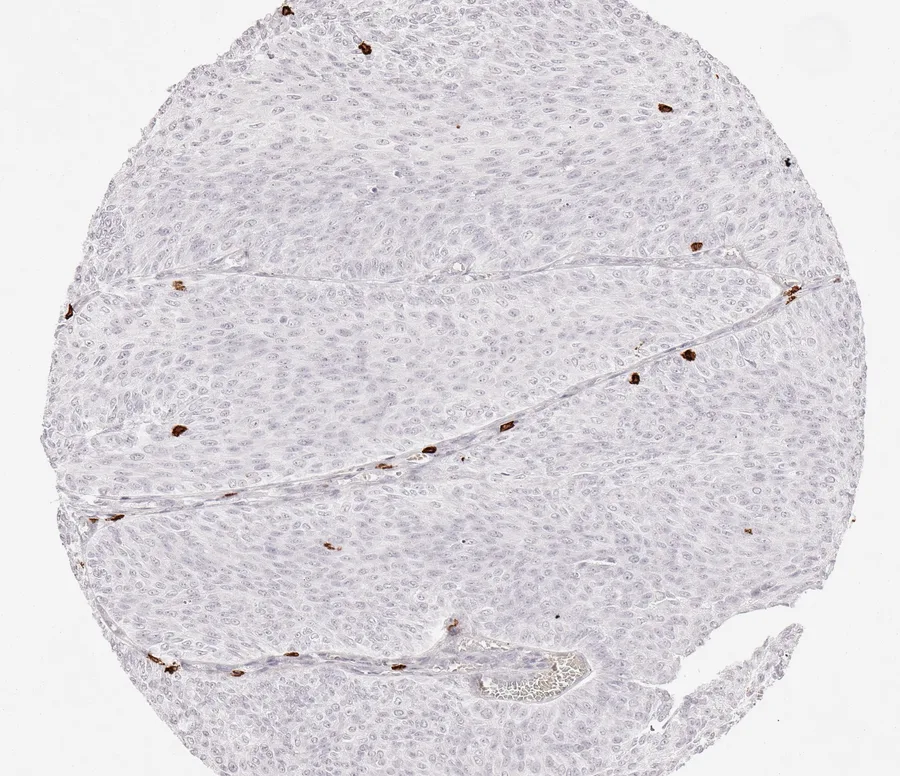 Immunohistochemistry of human CD8 with anti-CD8 clone TC8 (DIA-TC8) in FFPE tissue – some scattered CD8-positive lymphocytes in papillary non-invasive urothelial carcinoma of the urinary bladder; figure 24 of the ONCOdianova CD8 gallery.