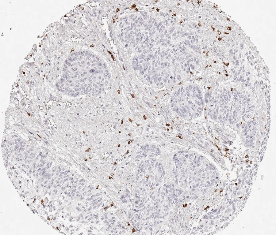 Immunohistochemistry of human CD8 with anti-CD8 clone TC8 (DIA-TC8) in FFPE tissue – CD8-positive lymphocytes in vaginal squamous cell carcinoma; figure 17 of the ONCOdianova CD8 gallery.