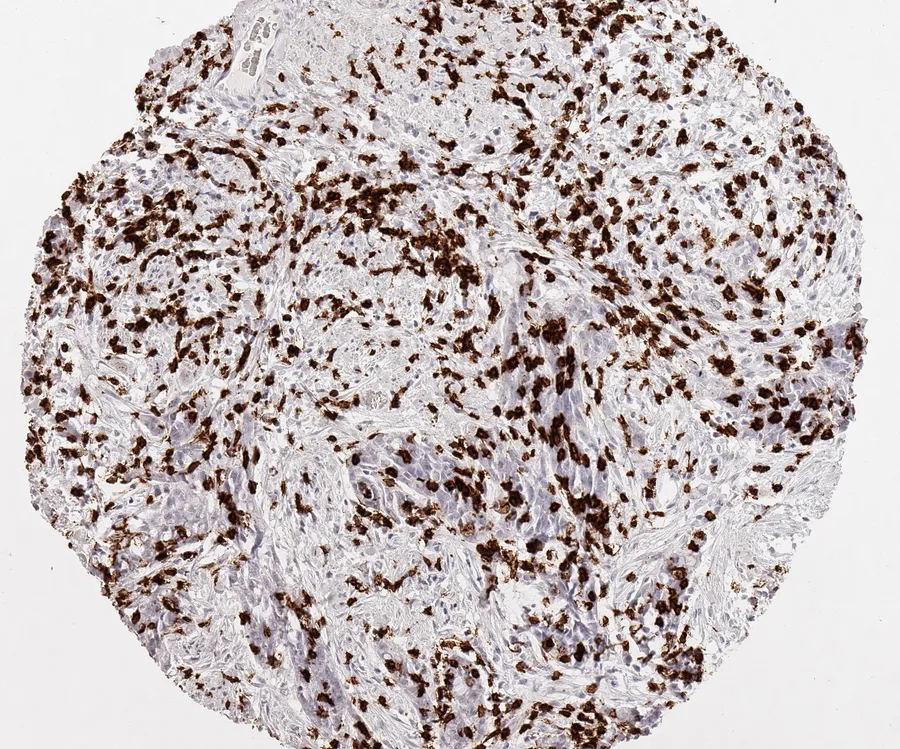 Immunohistochemistry of human CD8 with anti-CD8 clone TC8 (DIA-TC8) in FFPE tissue – very dense infiltration by CD8-positive lymphocytes in vaginal squamous cell carcinoma; figure 18 of the ONCOdianova CD8 gallery.