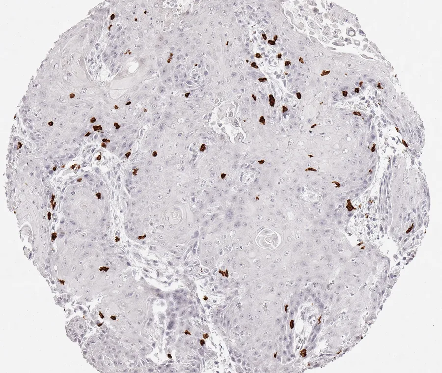 Immunohistochemistry of human CD8 with anti-CD8 clone TC8 (DIA-TC8) in FFPE tissue – scattered CD8-positive lymphocytes, predominantly located at the stroma–epithelium interface in squamous cell carcinoma of the vulva; figure 13 of the ONCOdianova CD8 gallery.