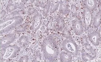 Tumor infiltrating lymphocytes in colorectal carcinoma (ONCOdianova reference image, datasheet V17, Fig. B).