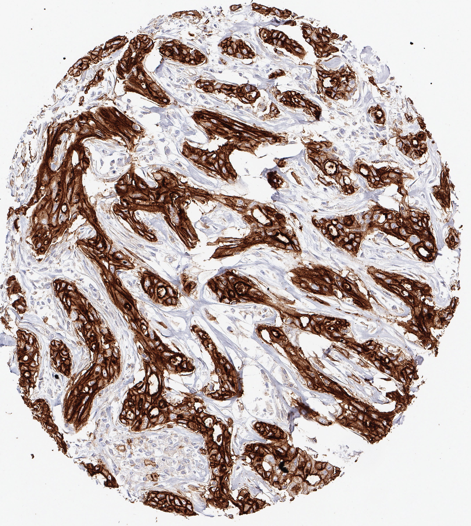 Product image of the ONCOdianova anti-CD73 antibody clone KK3: strong homogeneous CD73 immunostaining in a cholangiocellular carcinoma of the liver