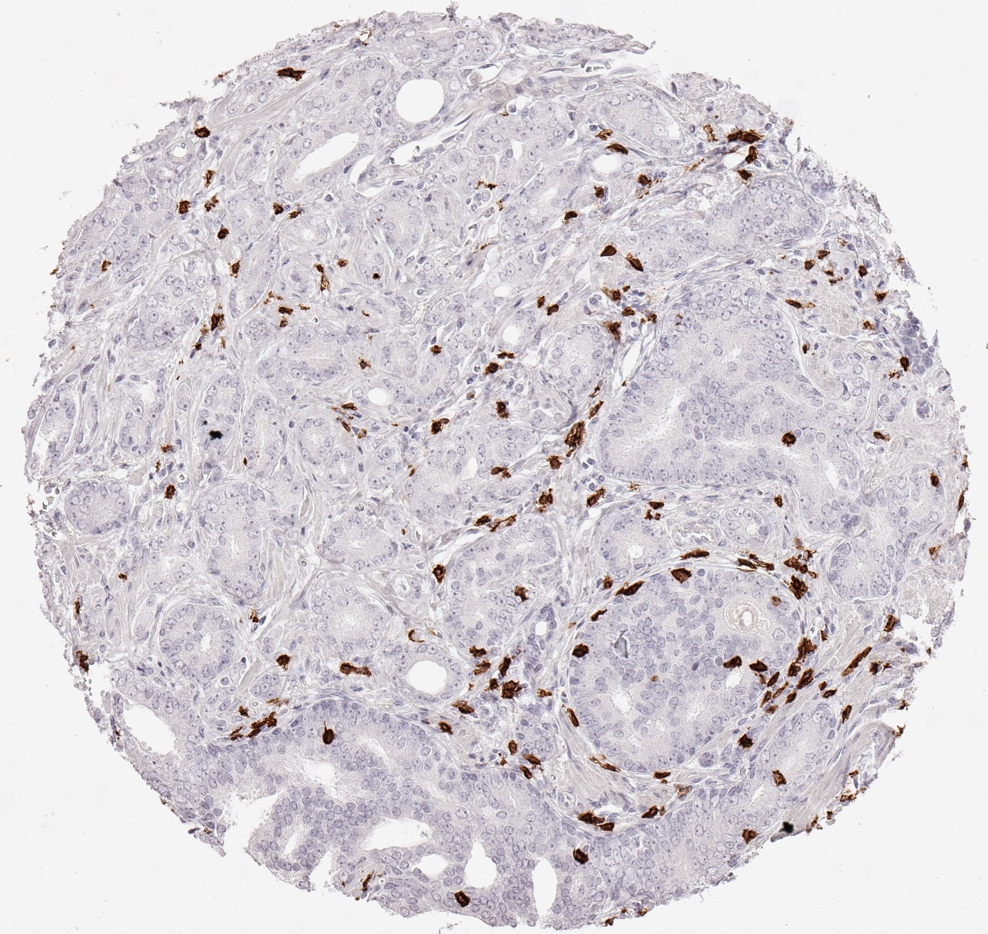 Product image of the ONCOdianova anti-CD8 antibody clone TC8: CD8 immunohistochemistry showing a dense infiltrate of CD8-positive lymphocytes in adenocarcinoma of the prostate