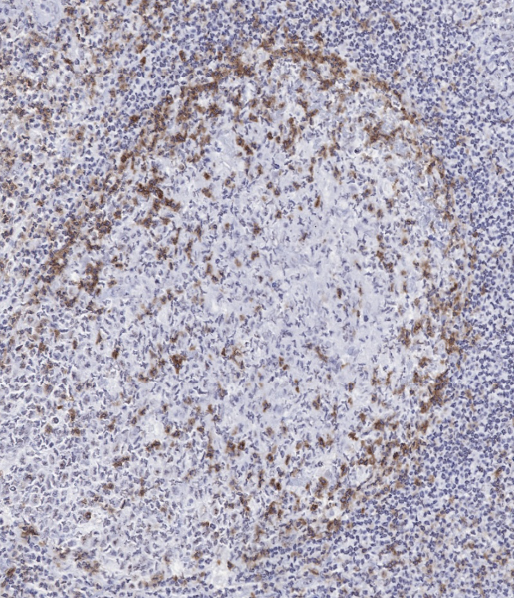 Product image of the ONCOdianova anti-TIGIT antibody clone TG2: TIGIT immunohistochemistry of human tonsil with numerous TIGIT-positive lymphocytes